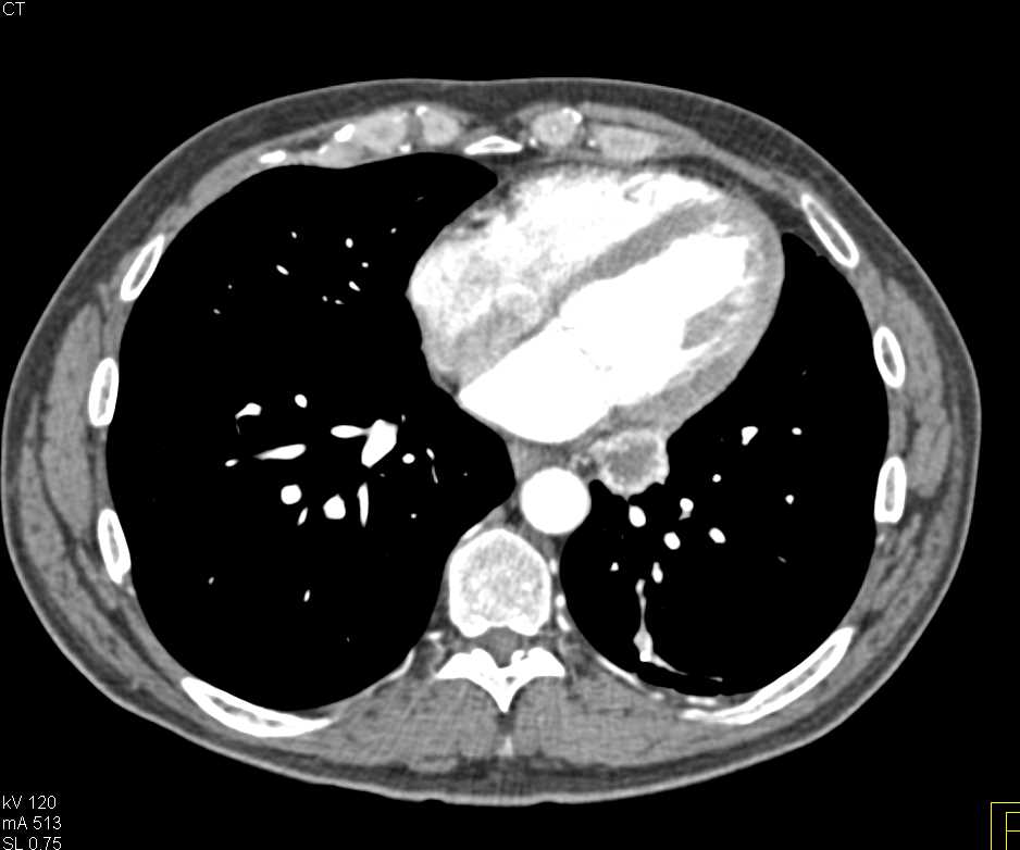 Recurrent Clear Cell Renal Cell Carcinoma (RCC) to Muscle and Lung - CTisus CT Scan