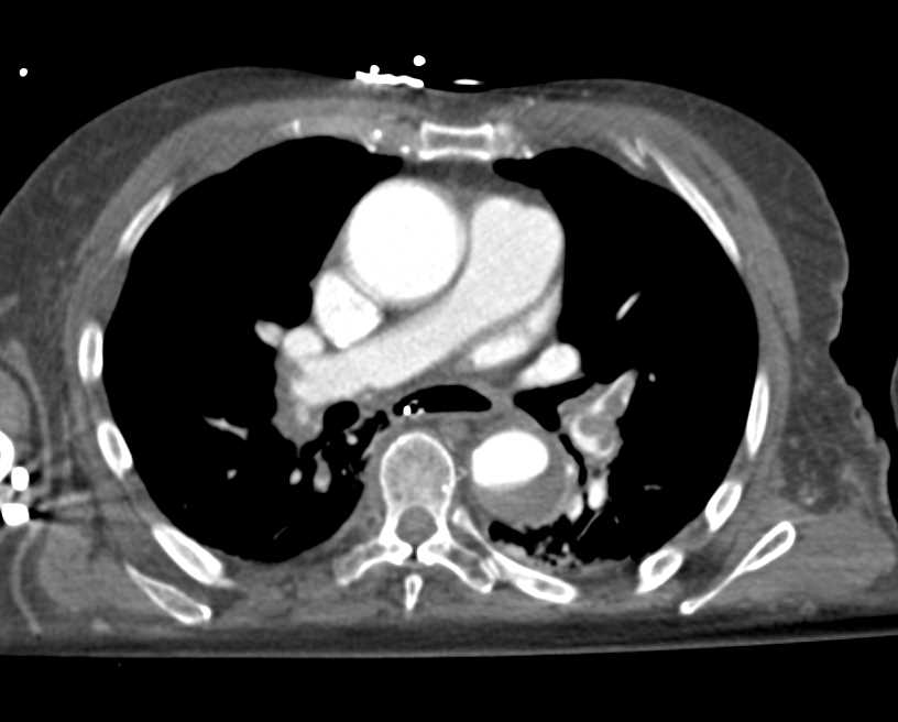 Chest Pain with Pulmonary Embolism (PE) and Aortic Dissection - CTisus CT Scan