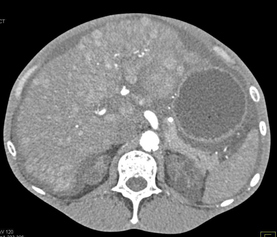 Pulmonary Embolism (PE) in Patient with Liver Metastases - CTisus CT Scan