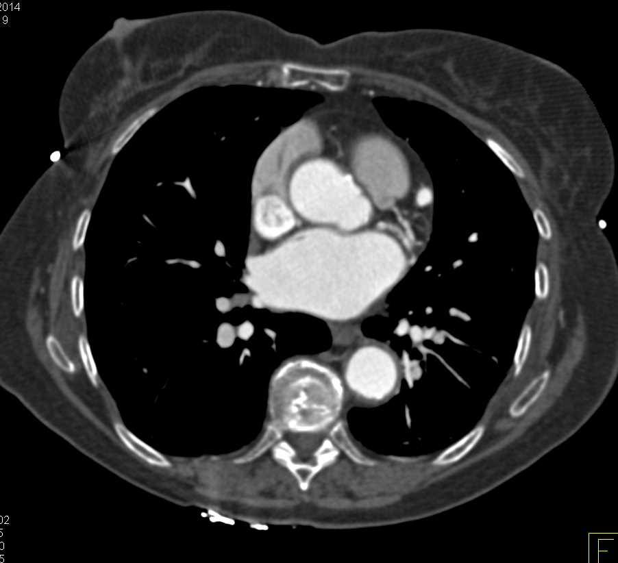 Small Right PA AV Malformation - CTisus CT Scan