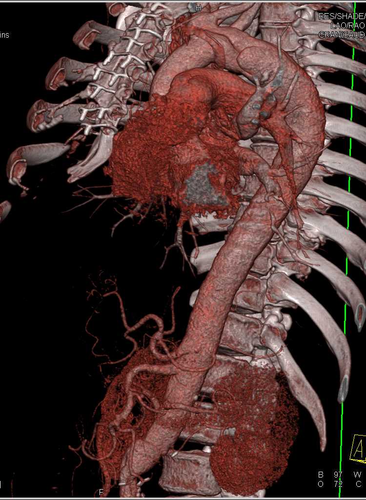 3D Map of Aortic Dissection with Repair - CTisus CT Scan
