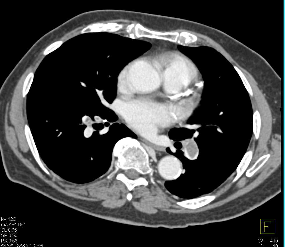 Pulmonary Embolism in a Patient with an Arteriovenous (AV) Fistulae for Dialysis - CTisus CT Scan