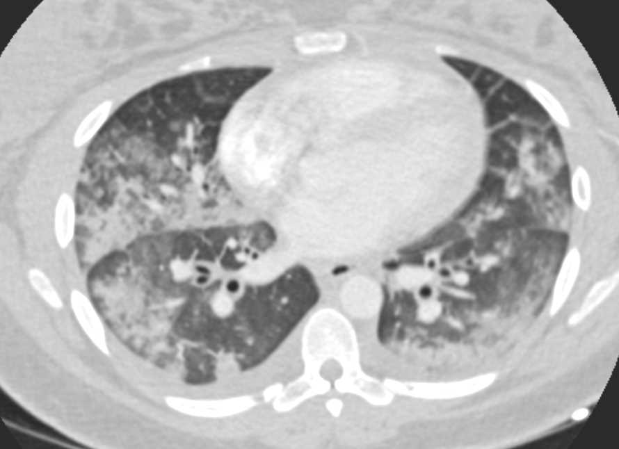 Pulmonary Hemorrhage - CTisus CT Scan