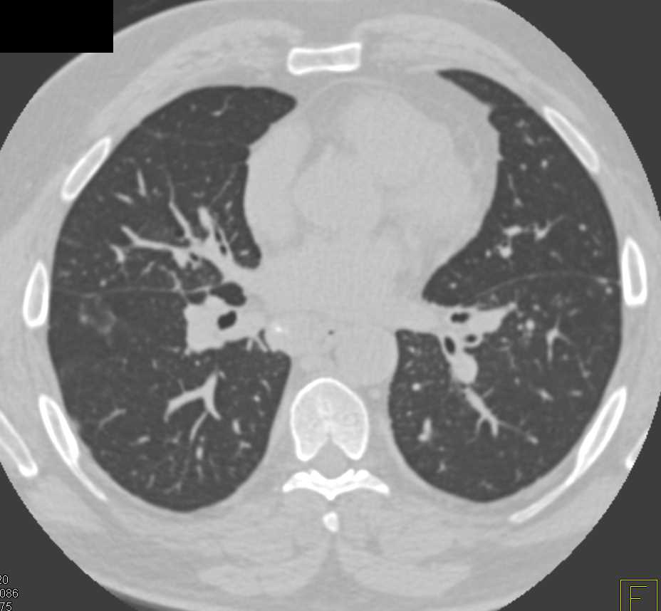 Sarcoidosis with Nodules - CTisus CT Scan