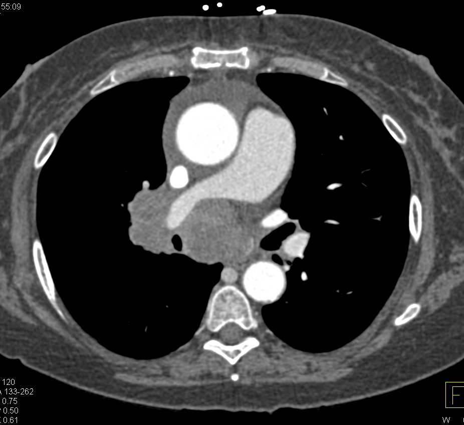 Superior Vena Cava (SVC) Syndrome due to Small Cell Lung Cancer - Chest