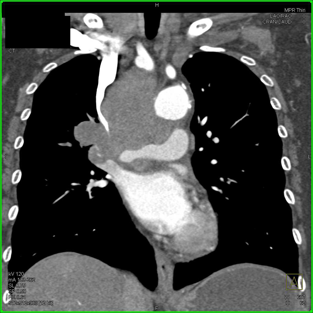 Superior Vena Cava (SVC) Syndrome due to Small Cell Lung Cancer - CTisus CT Scan
