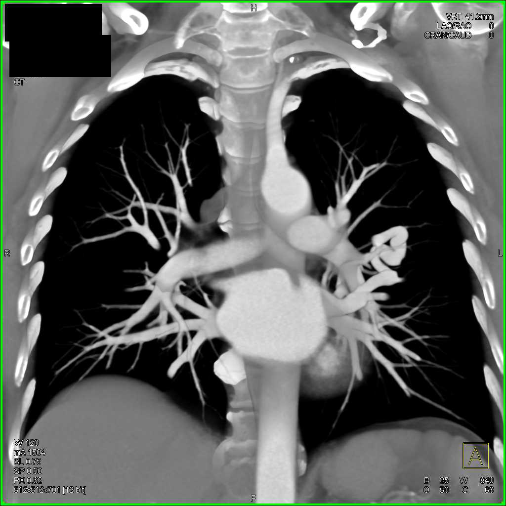 Pulmonary Arteriovenous Malformation (AVM) in 3D - CTisus CT Scan