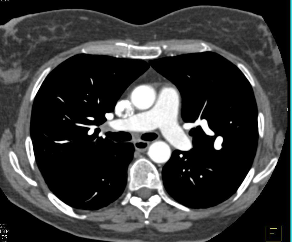 Pulmonary Arteriovenous Malformation (AVM) - CTisus CT Scan