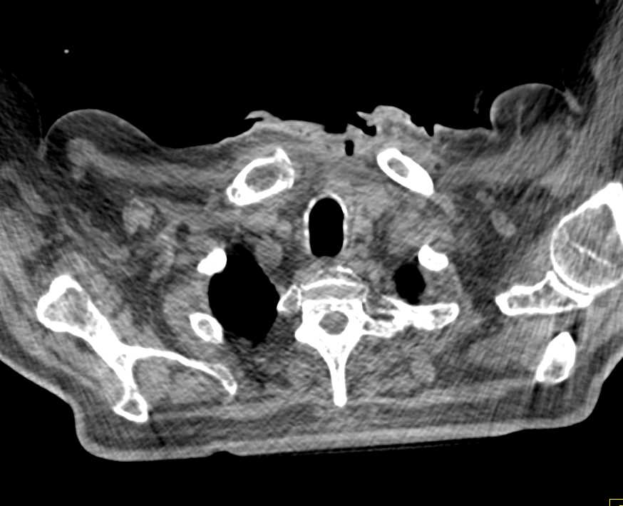 Osteomyelitis Sternum with Abscess - CTisus CT Scan