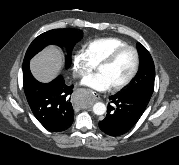 Lymphoma With Extensive Adenopathy Especially in the Mediastinum - CTisus CT Scan