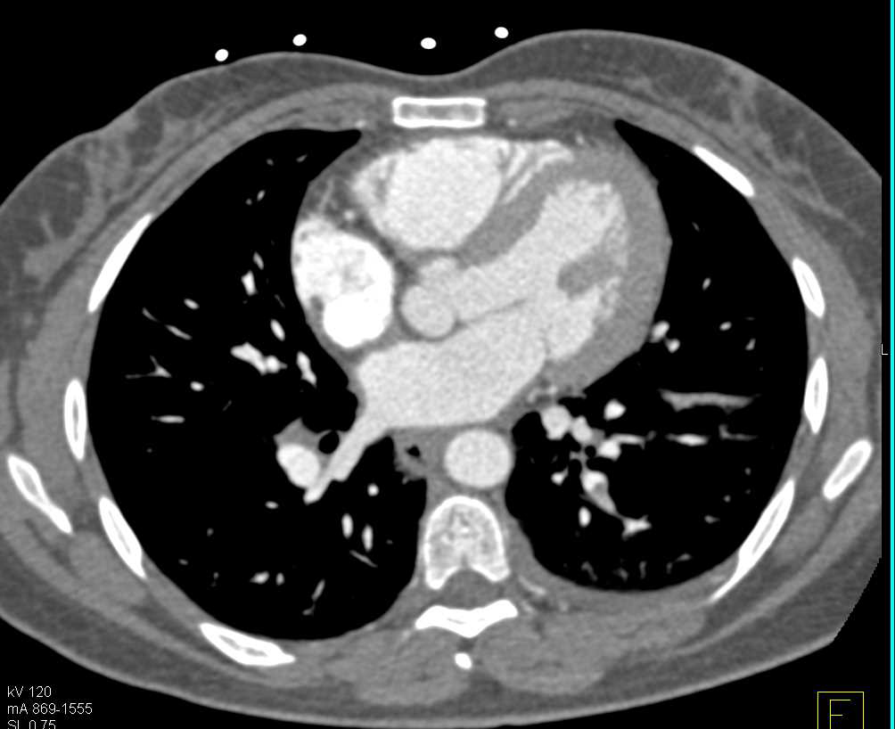 Bilateral Pulmonary Emboli with Infarction in Left Lower Lung - CTisus CT Scan