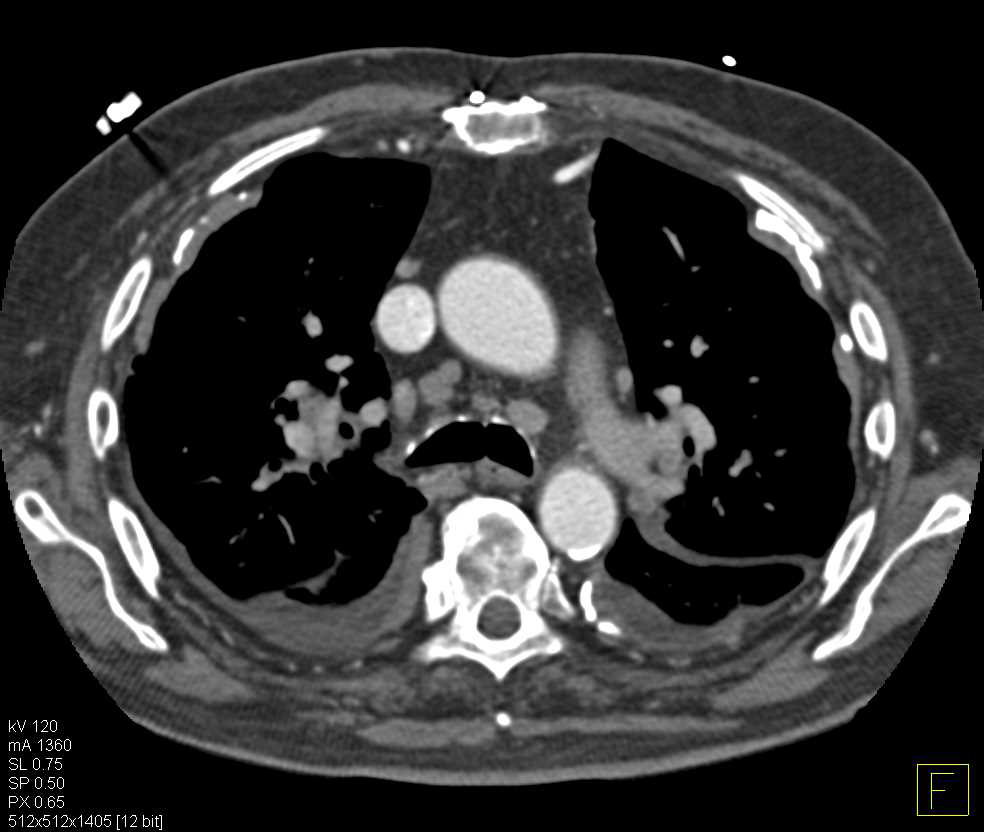 Asbestosis with Calcified Pleural Plaques - CTisus CT Scan