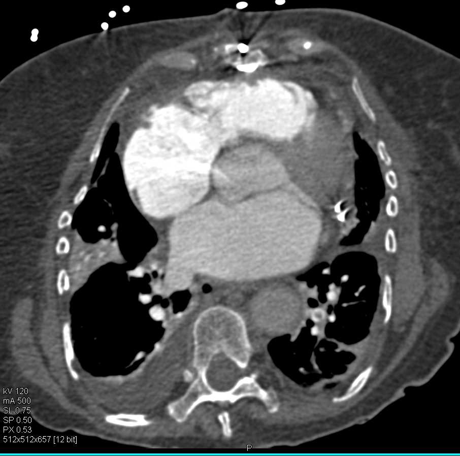 Incidental Pulmonary Embolism - CTisus CT Scan