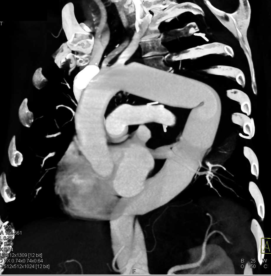 Repair of Thoracic Aorta - CTisus CT Scan