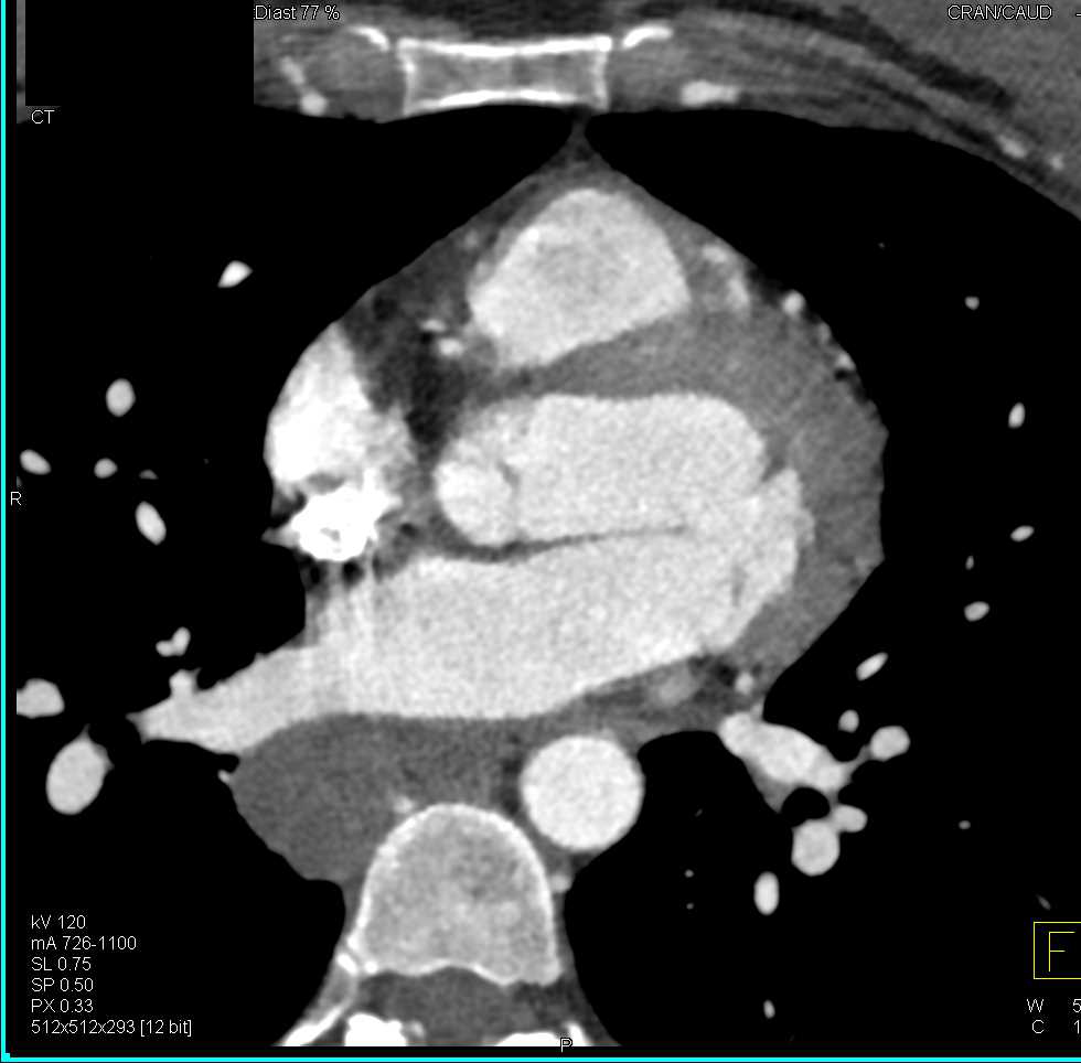 Bronchogenic Cyst - CTisus CT Scan