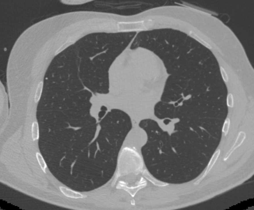 Air Trapping in the Lung - CTisus CT Scan