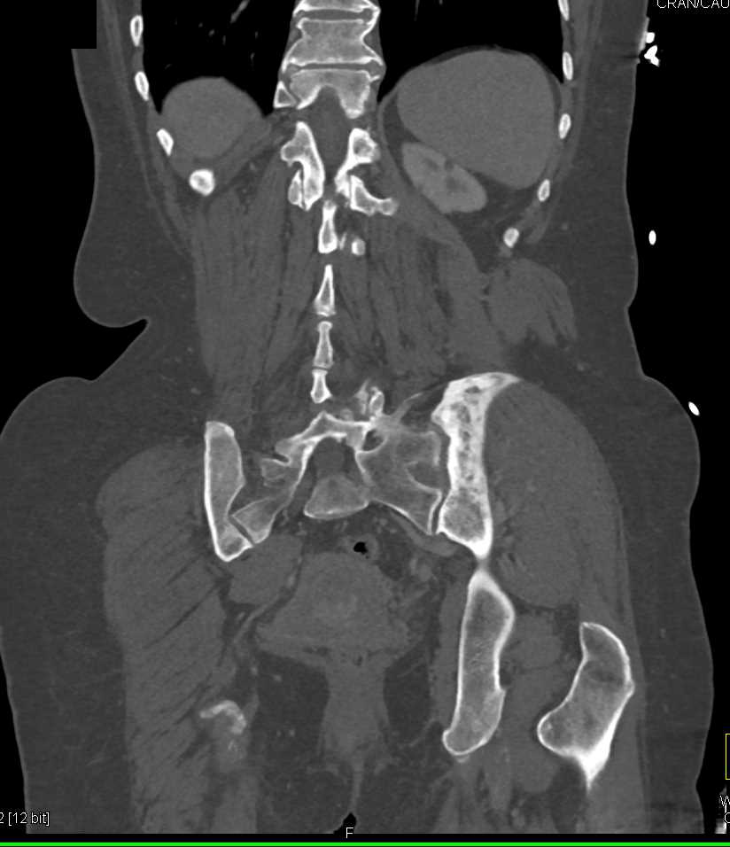 Paget's Disease and Incidental Pulmonary Embolism - CTisus CT Scan