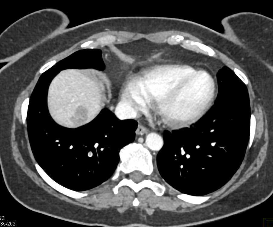 Pulmonary Embolism in Right Lower Lobe - CTisus CT Scan