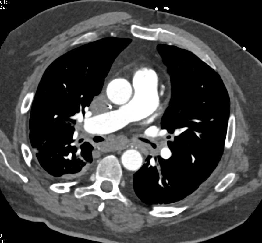 Subtle Pulmonary Embolism (PE) Right Lower Lung Seen Best on Coronal View - CTisus CT Scan