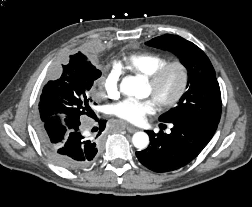 peritoneal mesothelioma cancer in abdominal lining