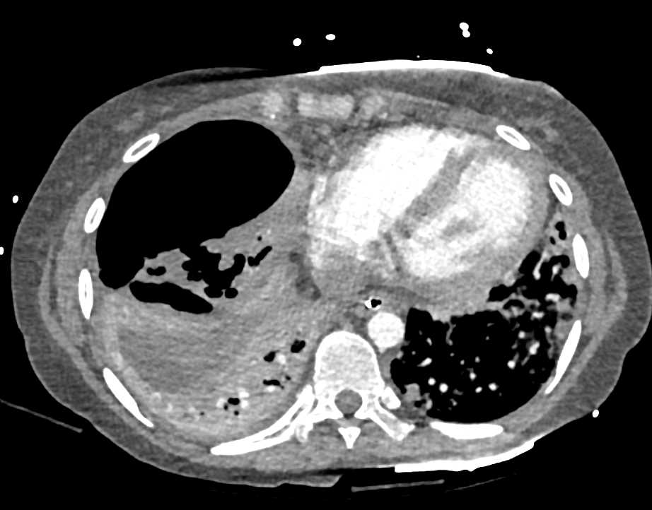 Hydropneumothorax Right Chest - Chest Case Studies - CTisus CT Scanning