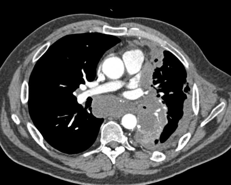 Lung Cancer with Peripancreatic Adenopathy - CTisus CT Scan