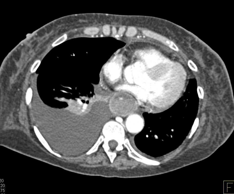 Lung Cancer with Impressive Adenopathy and Liver Metastases - CTisus CT Scan