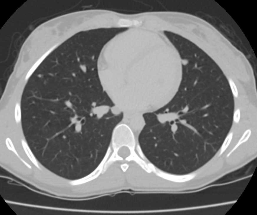 Metastatic Breast Cancer to Lung and Pleura - Chest Case Studies