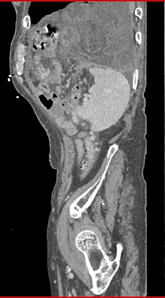 Ruptured Left Hemidiapragm - CTisus CT Scan