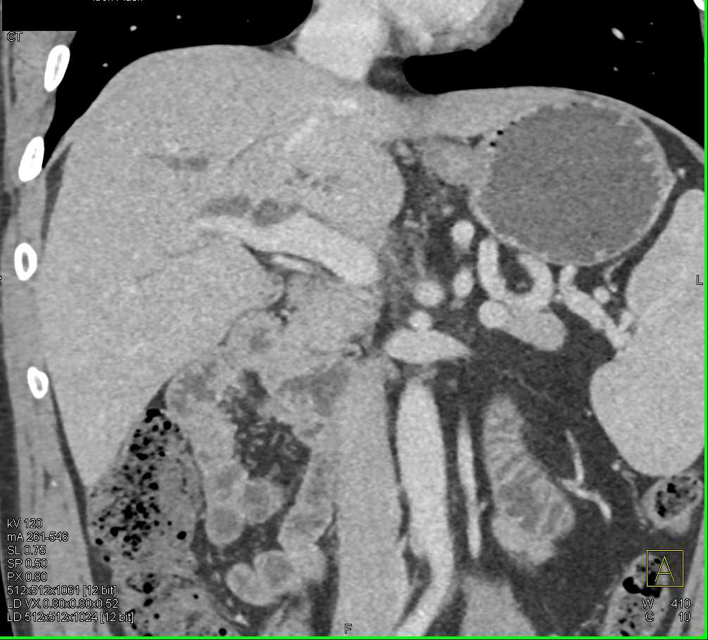 Incidental Pulmonary Embolism (PE) in Patient with Pancreatic Cancer and Carcinomatosis - CTisus CT Scan