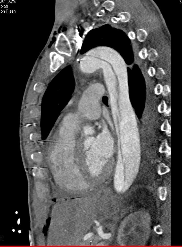 Mediastinal Post Op Changes Post Aortic Repair - CTisus CT Scan