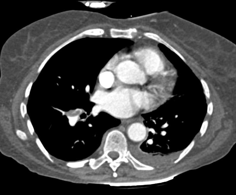 Right Pulmonary Embolism in a Post Operative Patient - CTisus CT Scan