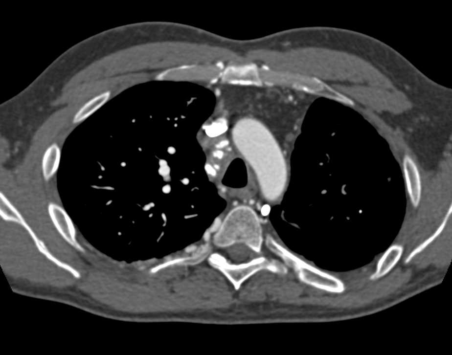 Superior Vena Cava (SVC) Occlusion with Mediastinal Varices - CTisus CT Scan