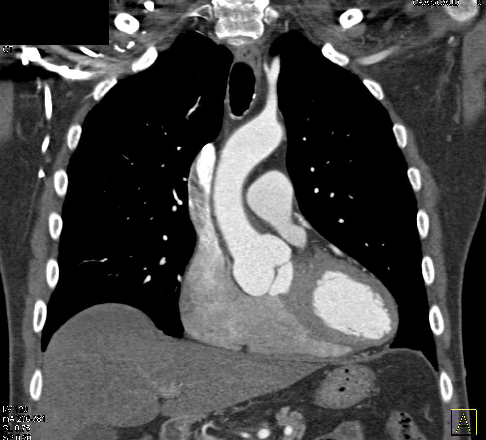 Dilated Aortic Root in a Patient with Marfan Syndrome - CTisus CT Scan