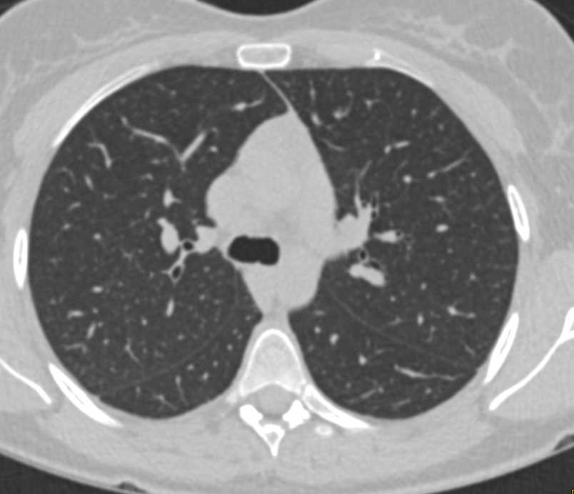 Increased Lower Lungs Markings due to Hypoinflation - CTisus CT Scan