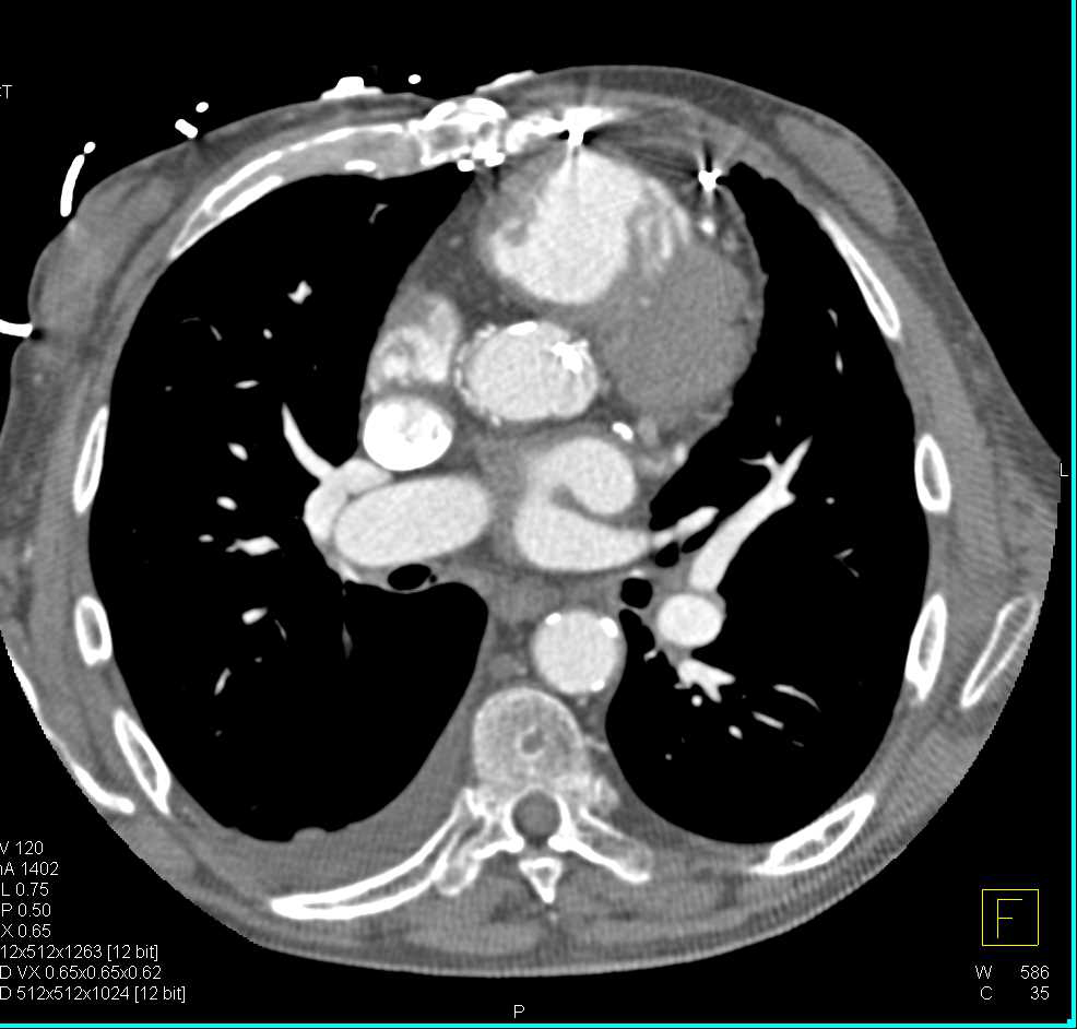 Hereditary Hemorrhagic Telangiectasia (HHT) Disease with Pulmonary and Hepatic Arteriovenous Malformations (AVMs) - CTisus CT Scan