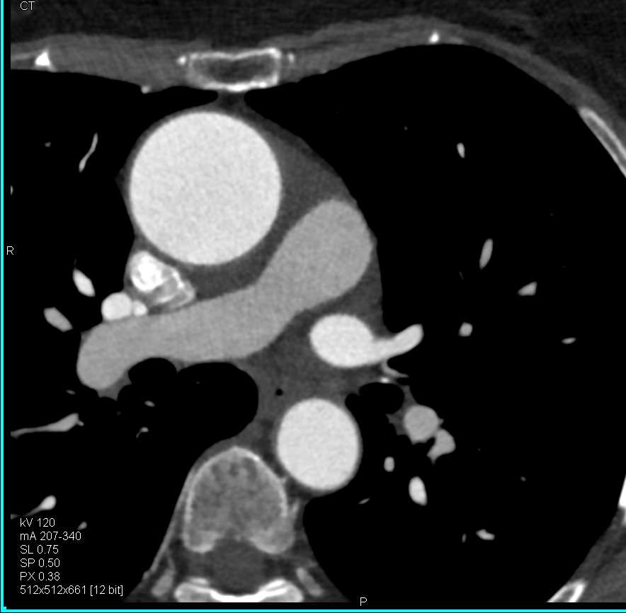 Dilated Ascending Thoracic Aorta - CTisus CT Scan