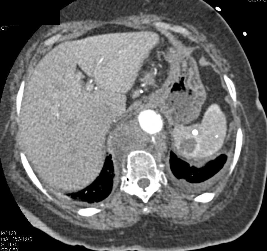 Bulky Subcrural Nodes in a Patient with Lymphoma - CTisus CT Scan