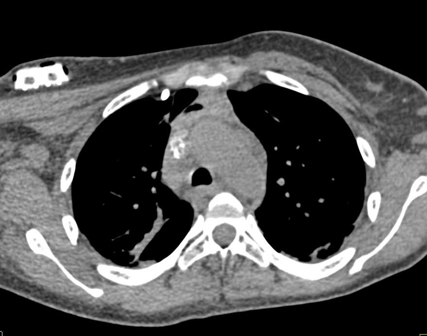 Mediastinal Abscess - CTisus CT Scan