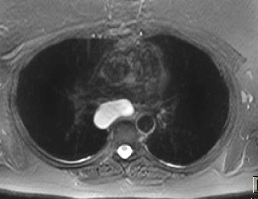 Duplication Cyst Mediastinum - CTisus CT Scan