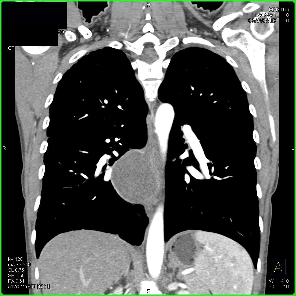 Bronchogenic Cyst Chest Case Studies CTisus CT Scanning