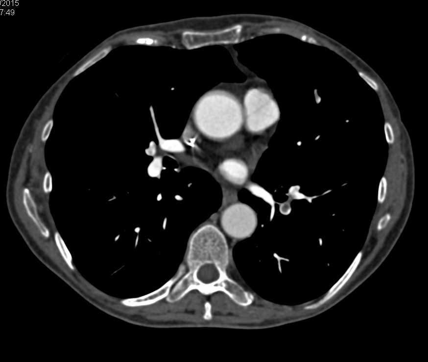 Incidental Pulmonary Emboli (PEs) in a Patient with Metastatic Disease to the Liver - CTisus CT Scan