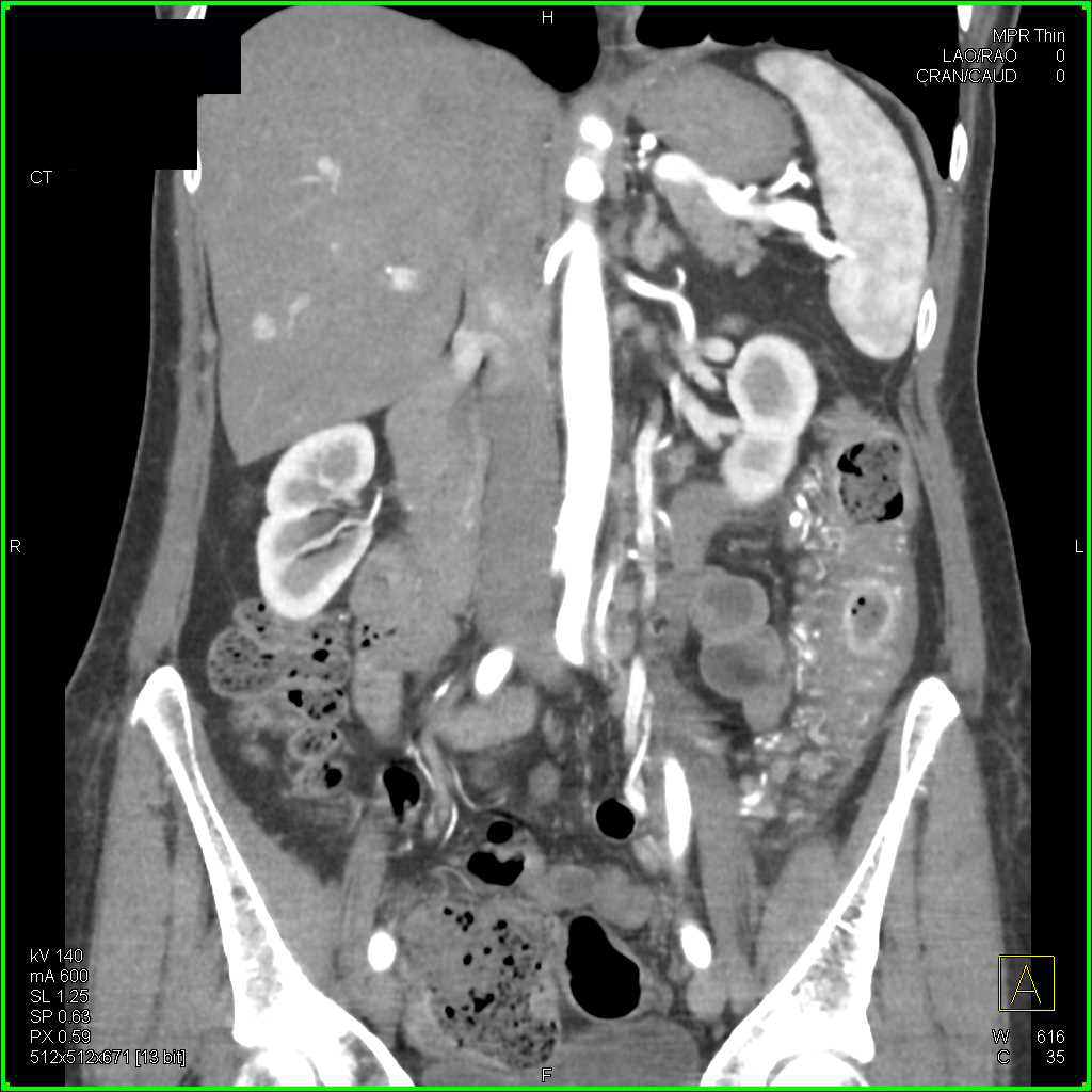 Ischemic Colitis Left Colon - CTisus CT Scan
