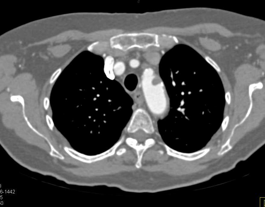 Clot in Aortic Arch and in Inferior Vena Cava (IVC) Filter - CTisus CT Scan