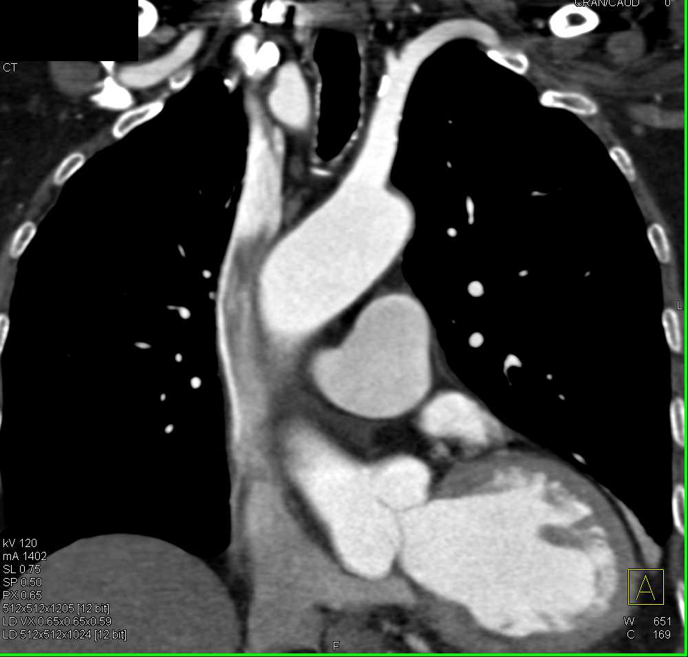 Plaque in Aortic Arch and Incidental Abdominal Aortic Aneurysm (AAA) - CTisus CT Scan