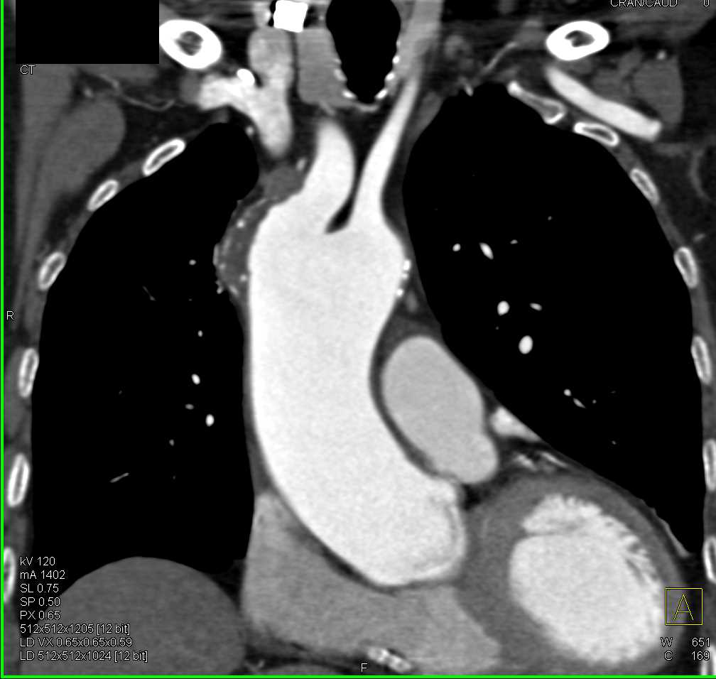 Plaque in Aortic Arch and Incidental Abdominal Aortic Aneurysm (AAA) - CTisus CT Scan