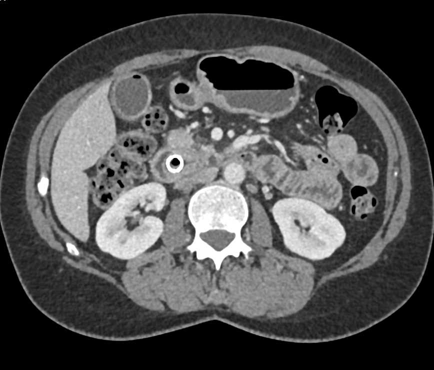Septic Emboli in a Patient with Pancreatic Cancer - Chest Case Studies