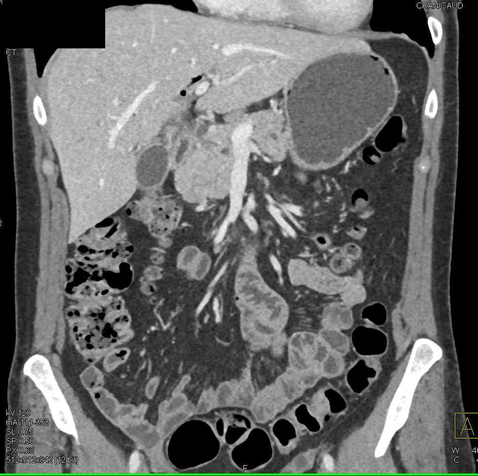 Septic Emboli in a Patient with Pancreatic Cancer - CTisus CT Scan