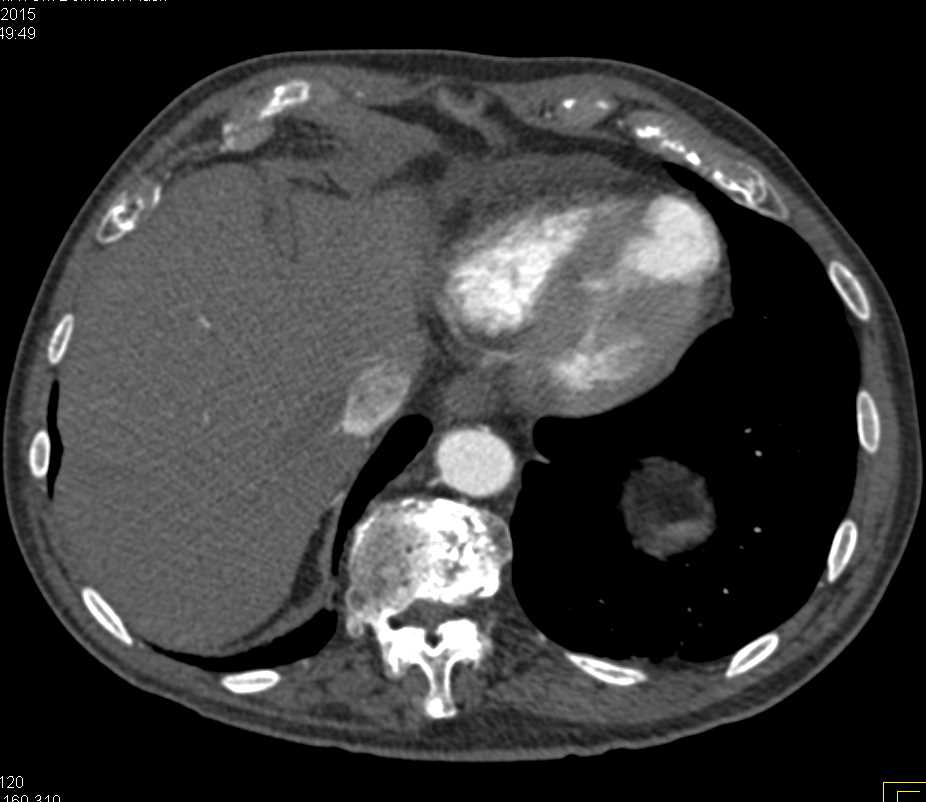 Abdominal Aorta CT Scan