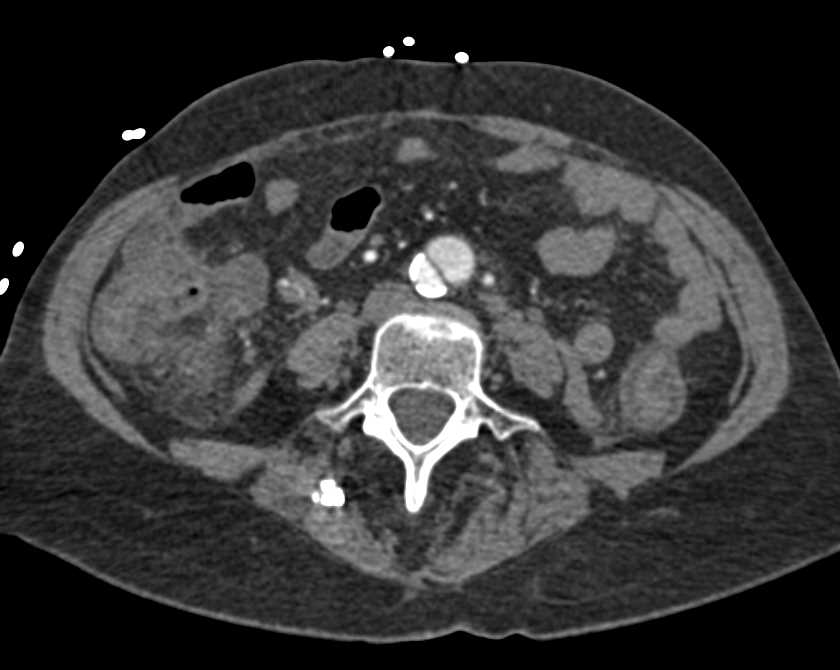 Dissection of the Abdominal Aorta - Chest Case Studies - CTisus CT Scanning